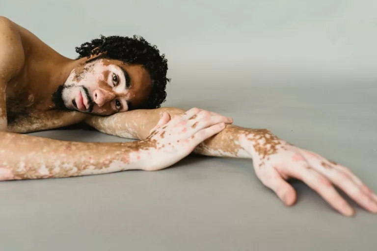 Black man with vitiligo lying on floor of studio